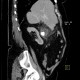 Phlegmonous cholecystitis, cholecystitis, gallstone, cholecystolithiasis: CT - Computed tomography